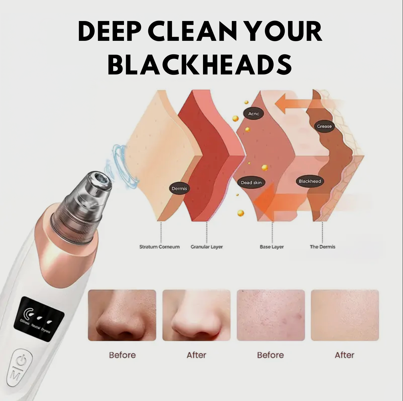 Romin™ — BlackHead Remover